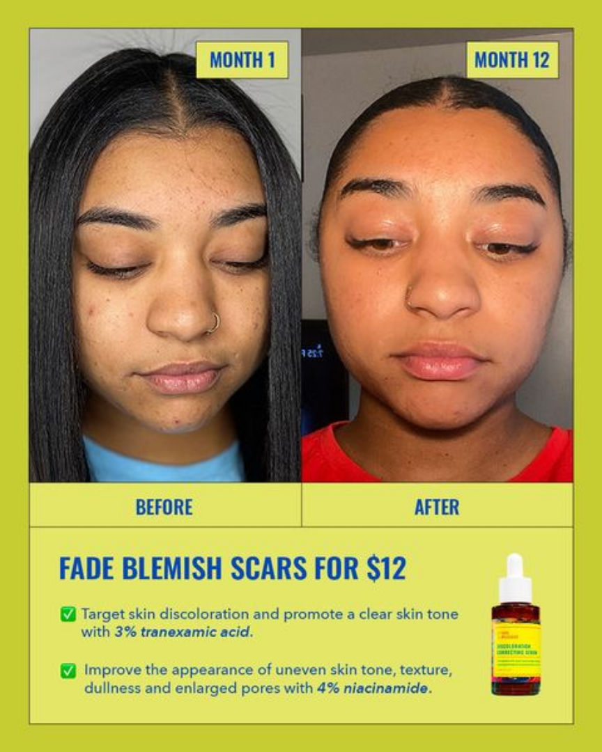 Before/After Ad Breakdown for Skincare — Before/After Meta ad example for Skincare